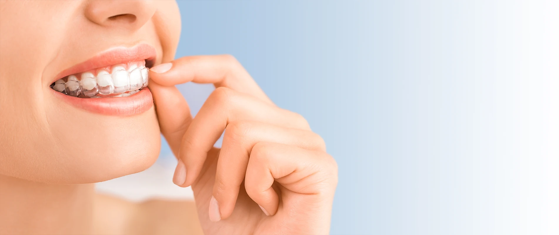 Person Wearing Their Invisalign Aligners